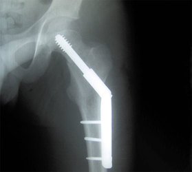 Long-Term Effects of Hip Fractures in the Elderly