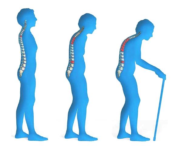 Osteoporosis - One out of Eight U.S. Adults Affected