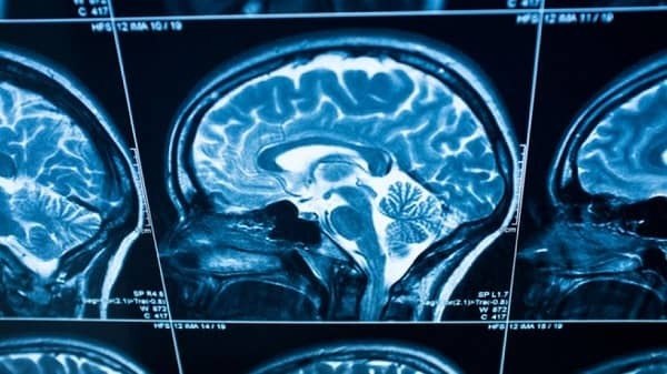 Tests May Hint at Alzheimer's 18 Years Before Diagnosis