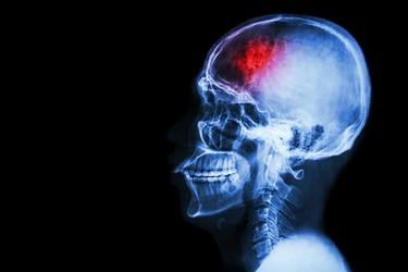 Strokes Impacting Younger Americans